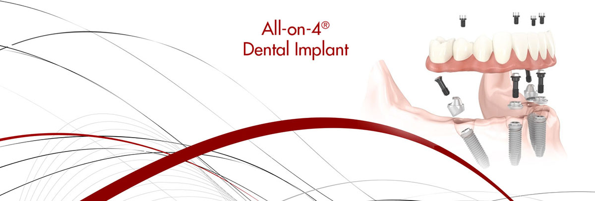 Delaware All-on-4 Dental Implants