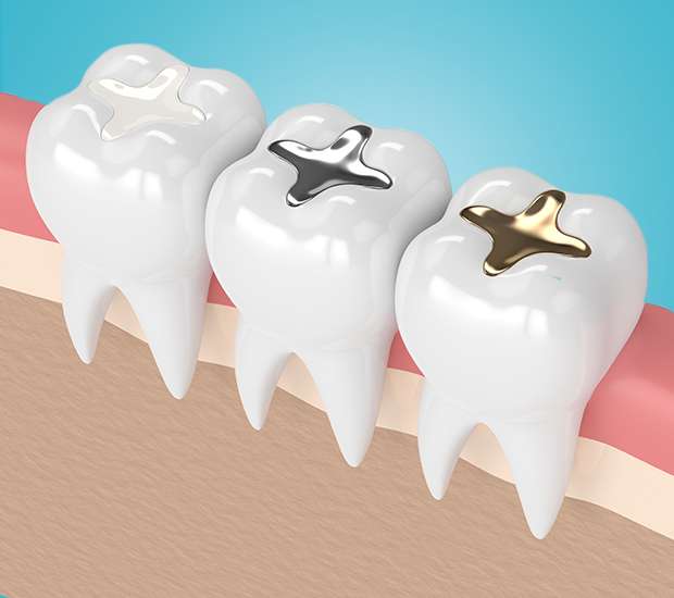 Delaware Tooth Colored Fillings
