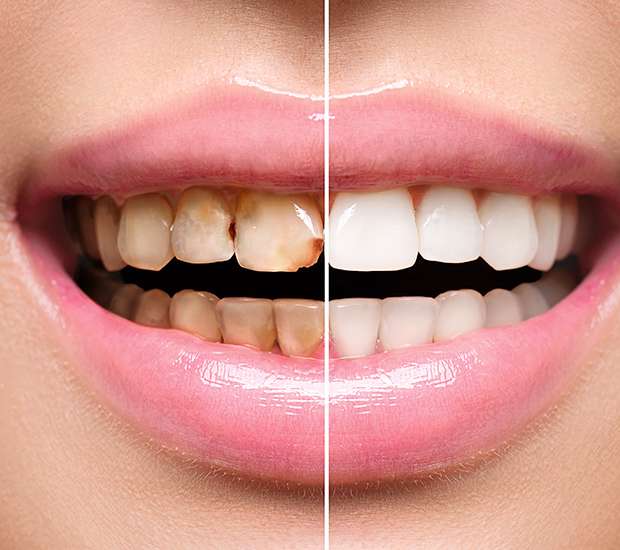 Sexton Dental Implant Restoration