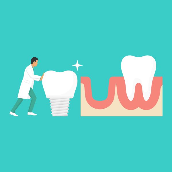 dental implants dental implants