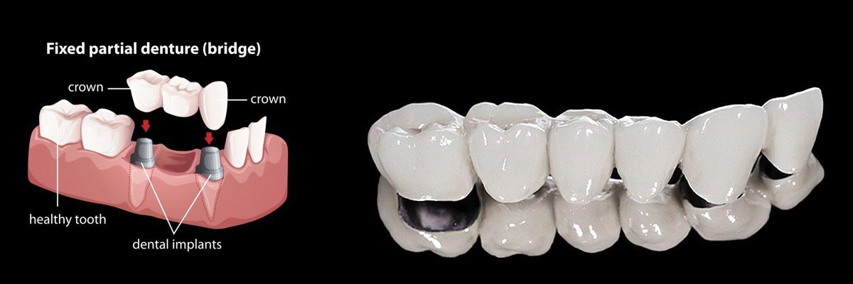 Delaware Dentures