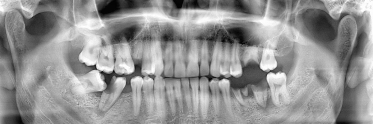 Delaware Wisdom Teeth Extraction